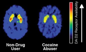 cocaine abuser brain